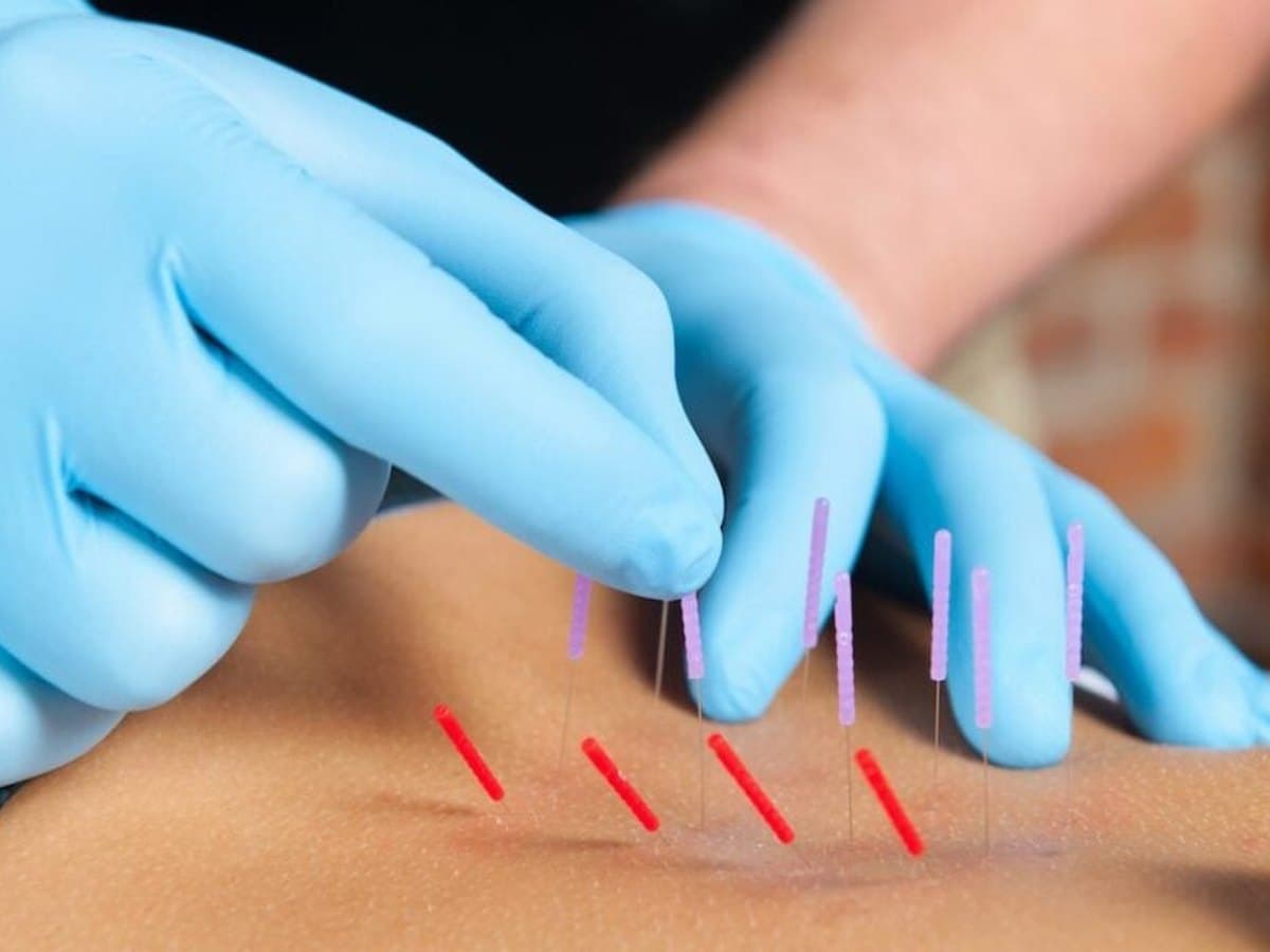 Gloved therapist inserting fine needles into a patient's upper back
